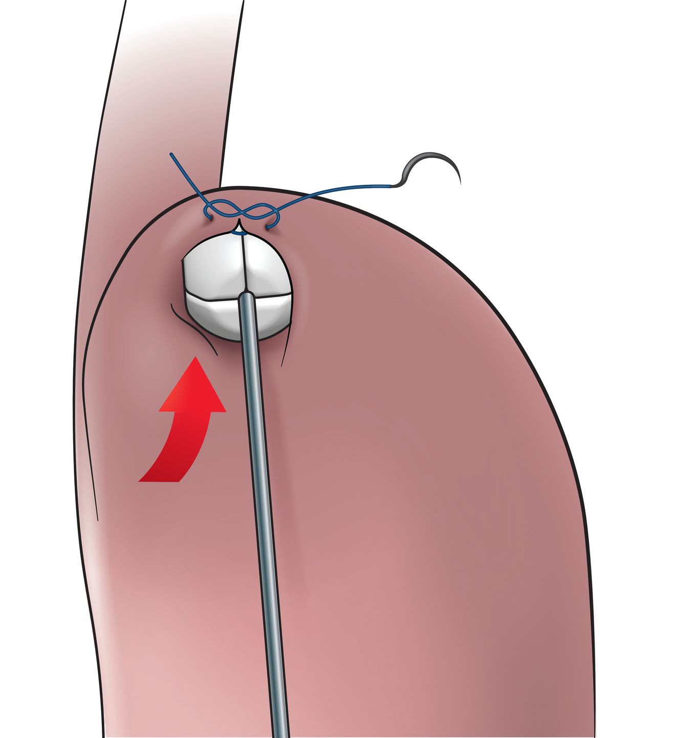 RefluxStop Placement 1