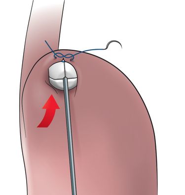 RefluxStop Placement 1