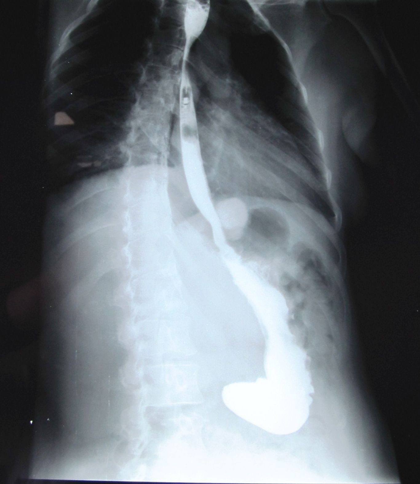 RefluxStop Patient X-Ray