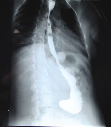 RefluxStop Patient X-Ray