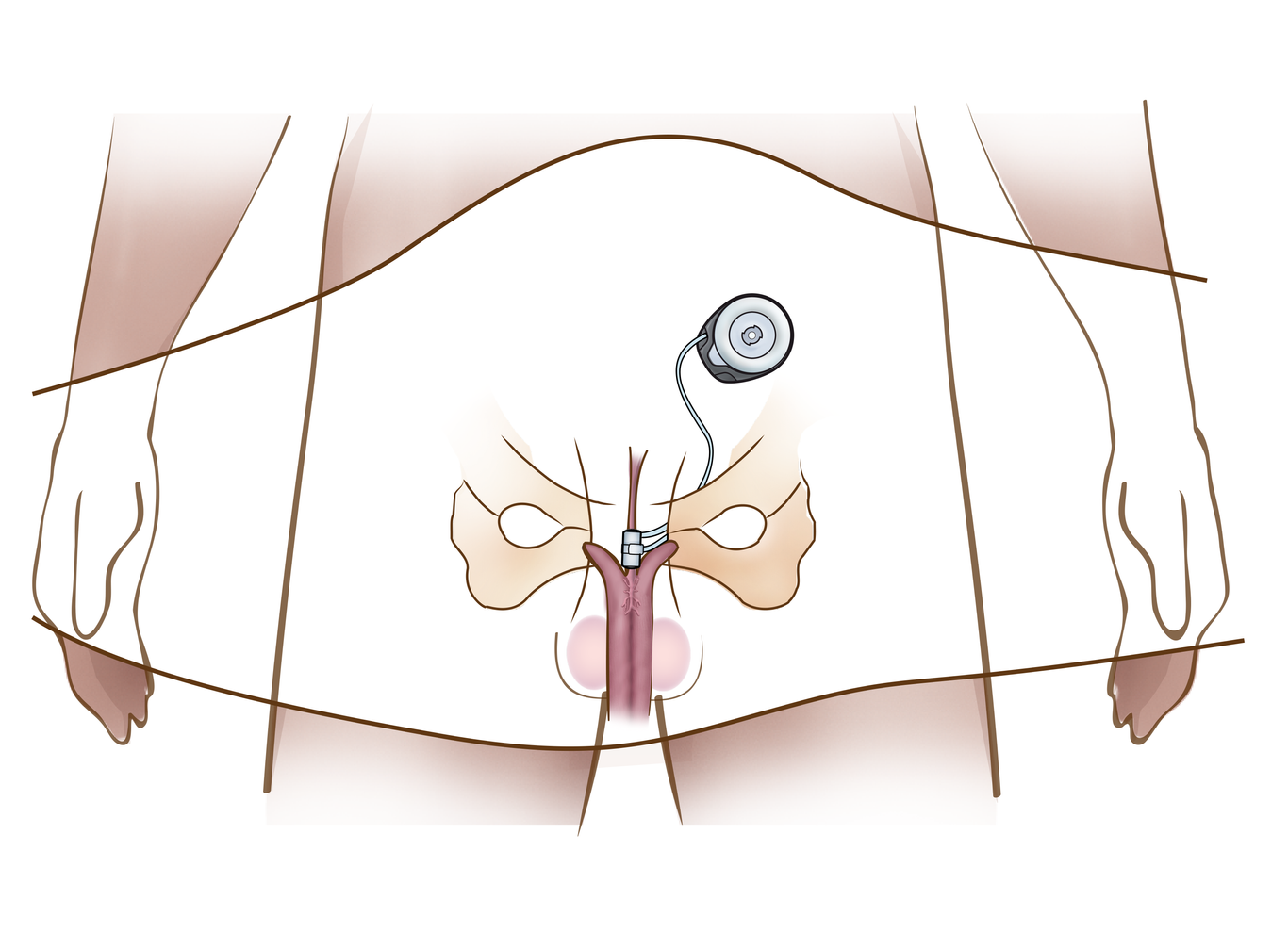PotencyFlow Placement